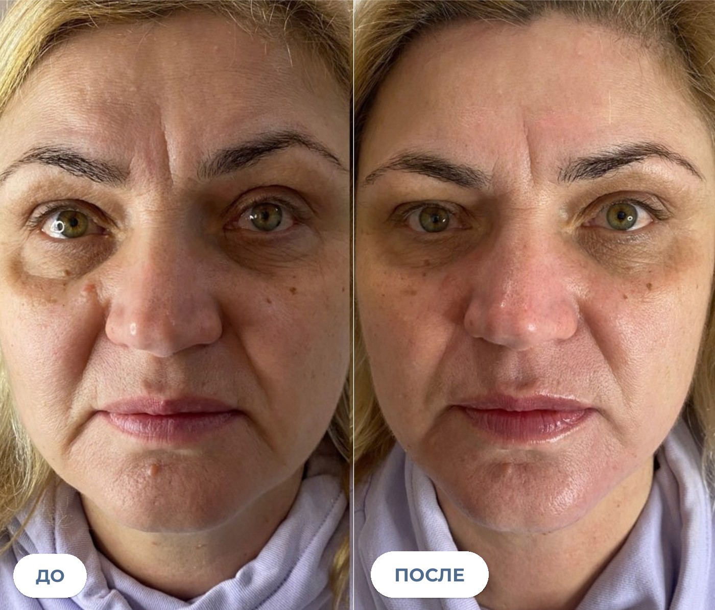 Лицо клиентки до и после двух сеансов EMS 3 в 1