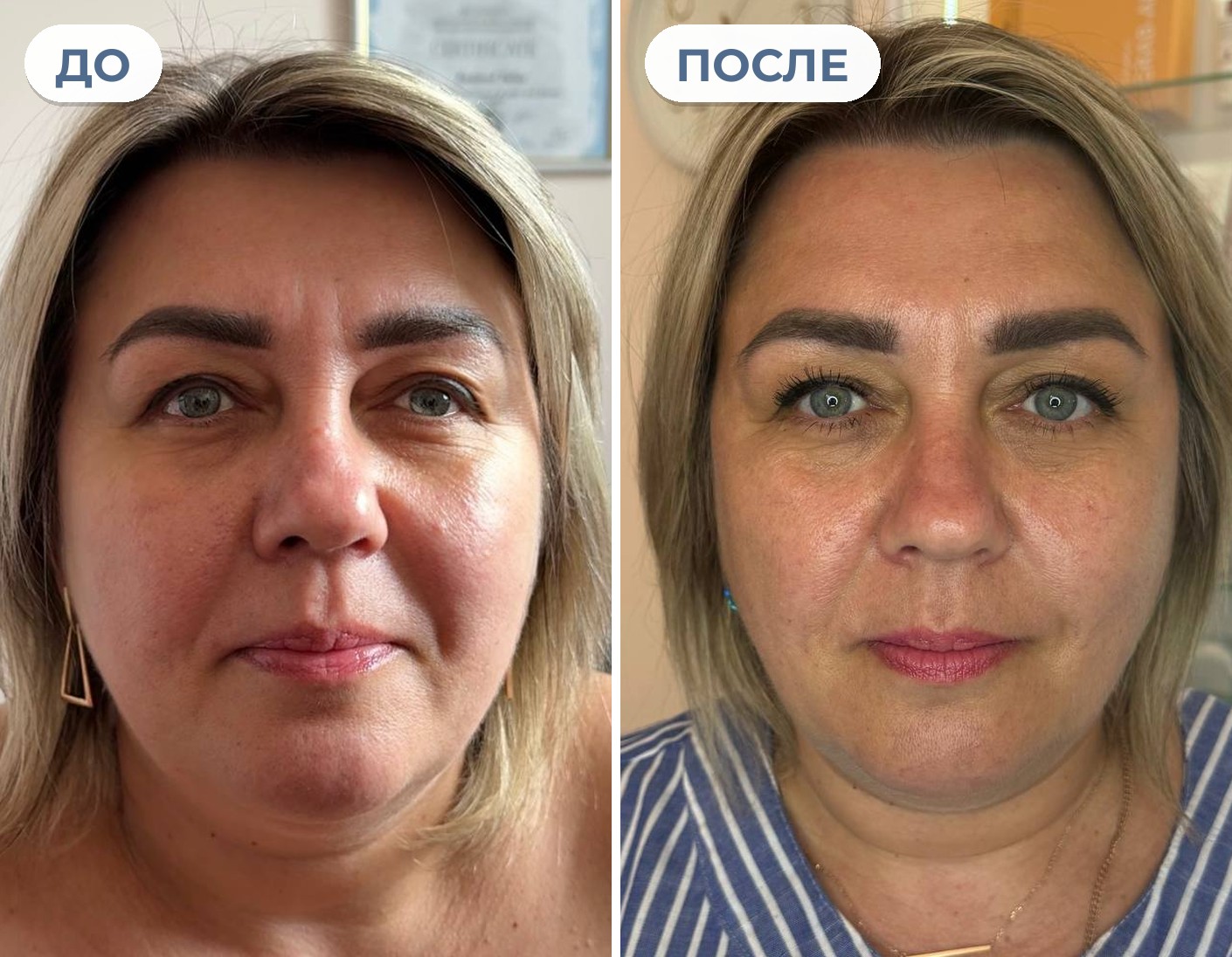 Та же клиентка до курса и после продолжения работы по плану специалиста